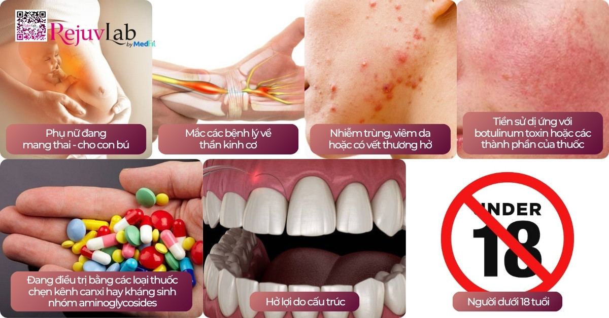 Tiêm botox cười hở lợi có hiệu quả không? Giải đáp từ Bác sĩ Thẩm mỹ 7 Tiêm botox cười hở lợi có hiệu quả không? Giải đáp từ Bác sĩ Thẩm mỹ 6