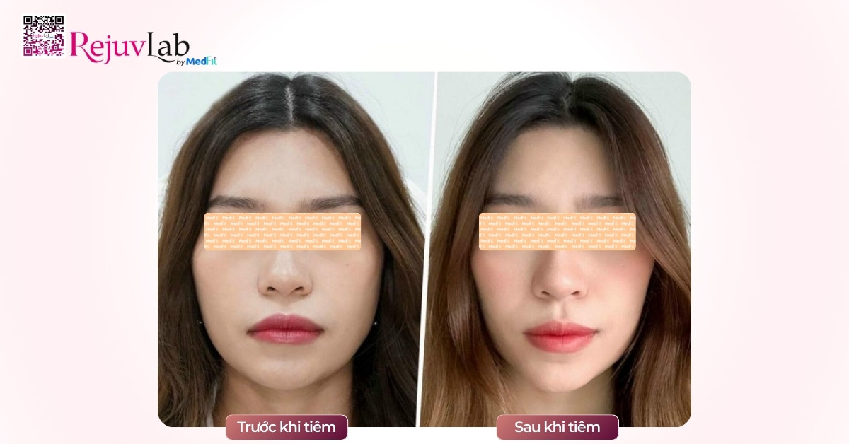 Tiêm botox gọn hàm bao nhiêu cc? Sự thật về cc và unit cần biết trước khi tiêm 7 Tiêm botox gọn hàm bao nhiêu cc? Sự thật về cc và unit cần biết trước khi tiêm 6