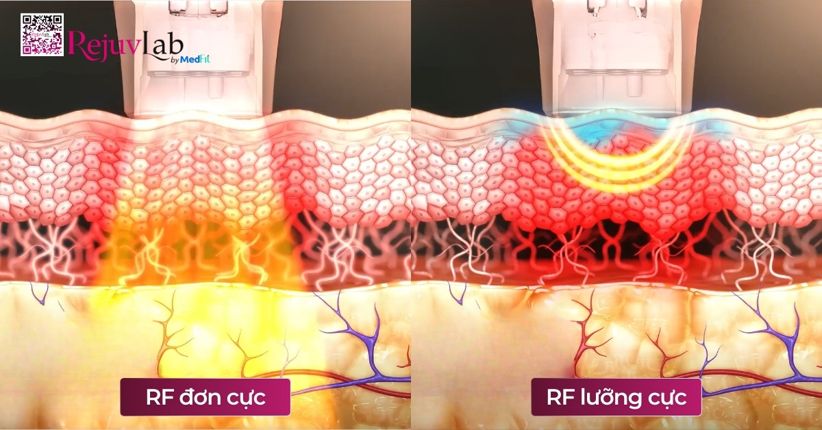 So sánh Thermage FLX và Density: Đâu là công nghệ xóa nhăn, nâng cơ hoàn hảo cho bạn? 9 So sánh Thermage FLX và Density: Đâu là công nghệ xóa nhăn, nâng cơ hoàn hảo cho bạn? 8