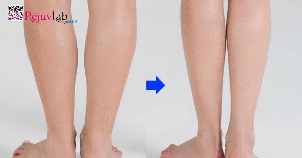 Tiêm botox thon gọn bắp chân: Bí quyết sở hữu đôi chân thon gọn như người mẫu 6 Tiêm botox thon gọn bắp chân: Bí quyết sở hữu đôi chân thon gọn như người mẫu 5