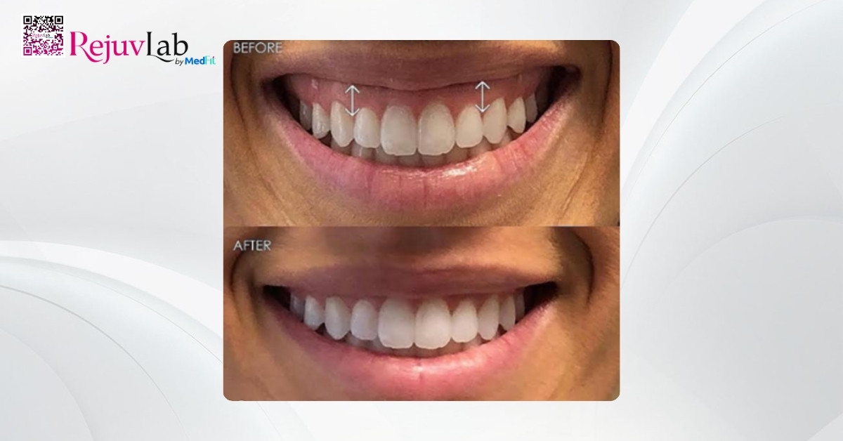 Tiêm botox cười hở lợi có hiệu quả không? Giải đáp từ Bác sĩ Thẩm mỹ 9 Tiêm botox cười hở lợi có hiệu quả không? Giải đáp từ Bác sĩ Thẩm mỹ 8