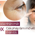 Tiêm botox xóa nhăn mắt: Giải pháp làm mờ vết chân chim thần tốc