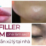 Tiêm filler bị bầm phải làm sao? Hướng dẫn xử lý tại nhà