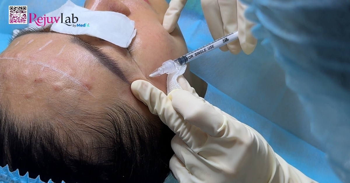 Tiêm botox xóa nhăn mắt: Giải pháp làm mờ vết chân chim thần tốc 2 Tiêm botox xóa nhăn mắt: Giải pháp làm mờ vết chân chim thần tốc 1