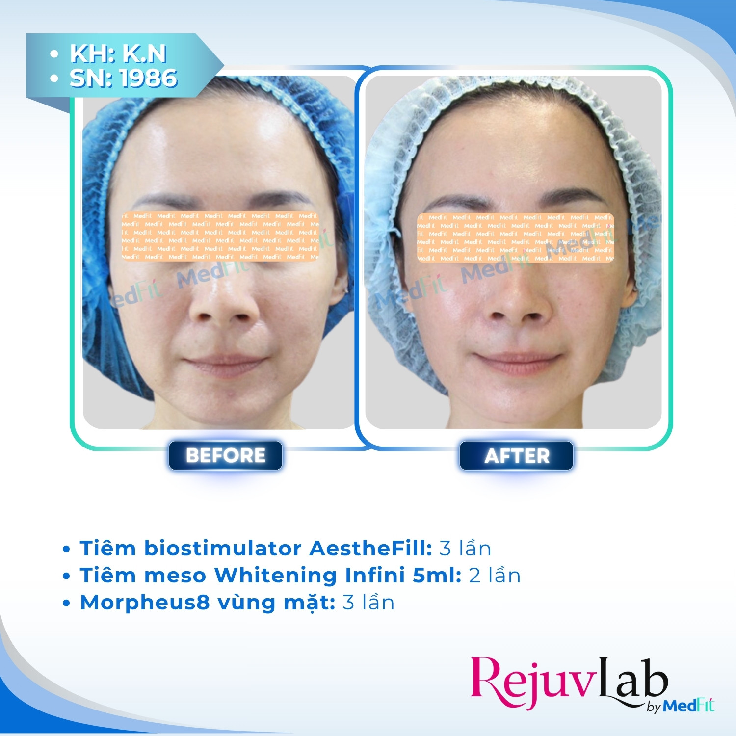 AestheFill: Giải pháp tái cấu trúc da và cải thiện thể tích từ bên trong 1
