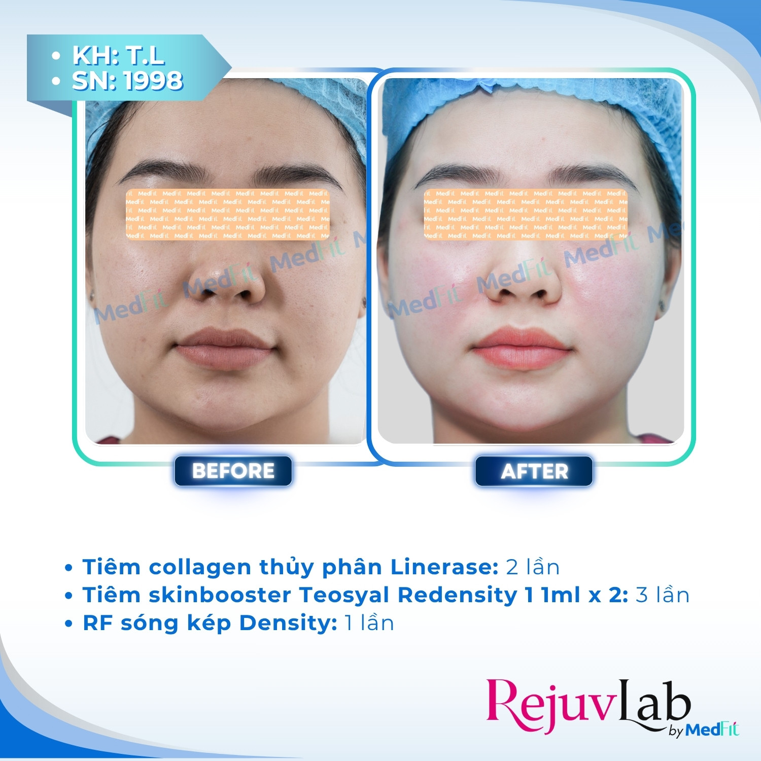 Linerase - Sản phẩm tiêm tăng sinh collagen và tái tạo mô liên kết 2