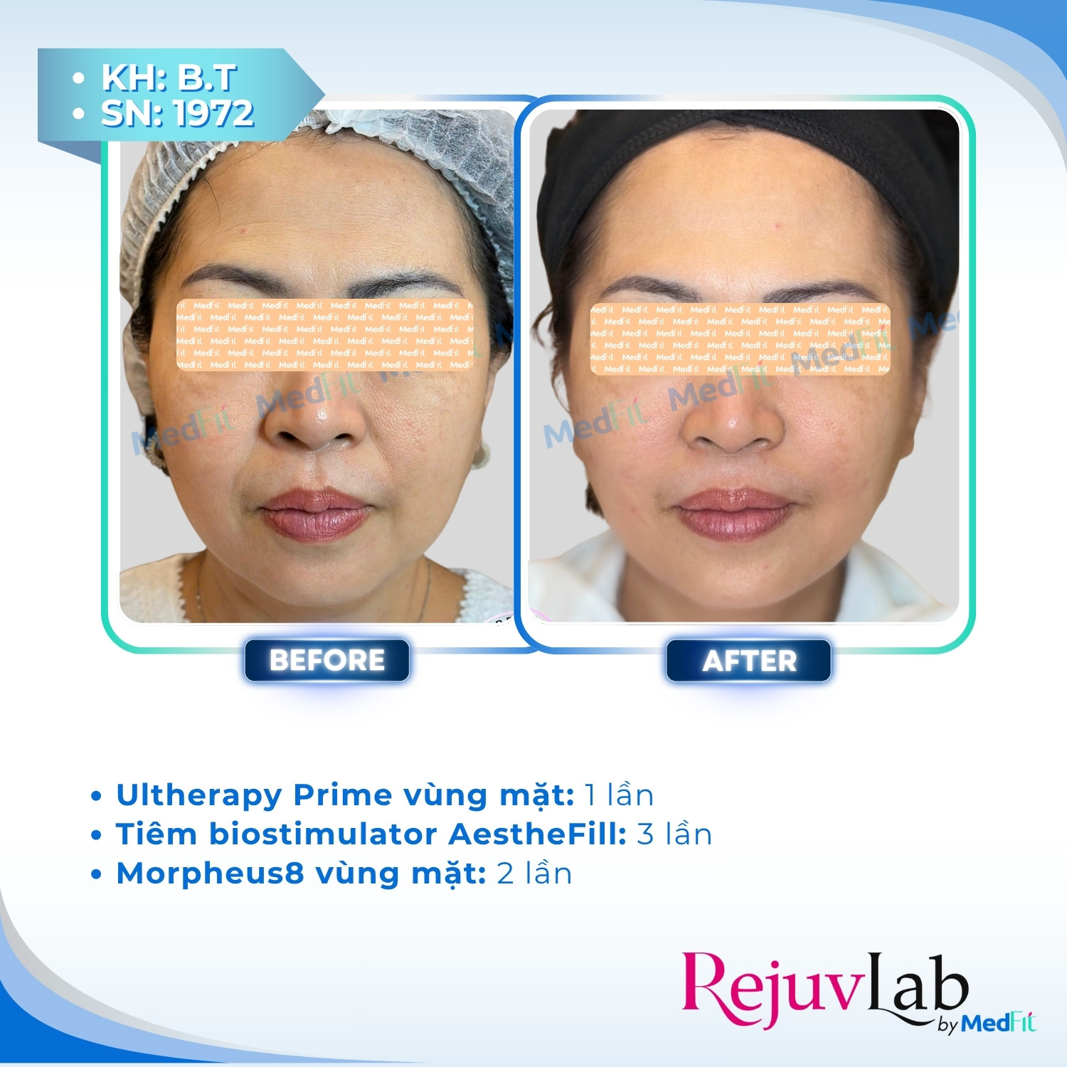 AestheFill: Giải pháp tái cấu trúc da và cải thiện thể tích từ bên trong 2