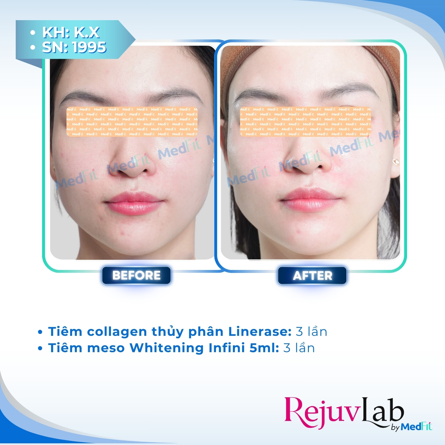 Linerase - Sản phẩm tiêm tăng sinh collagen và tái tạo mô liên kết 3