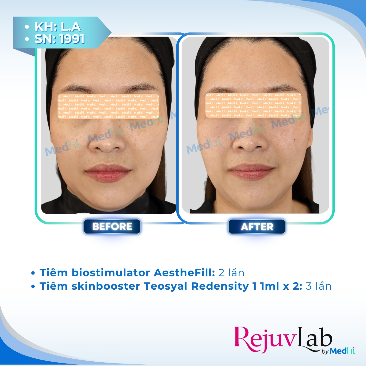 AestheFill: Giải pháp tái cấu trúc da và cải thiện thể tích từ bên trong 3