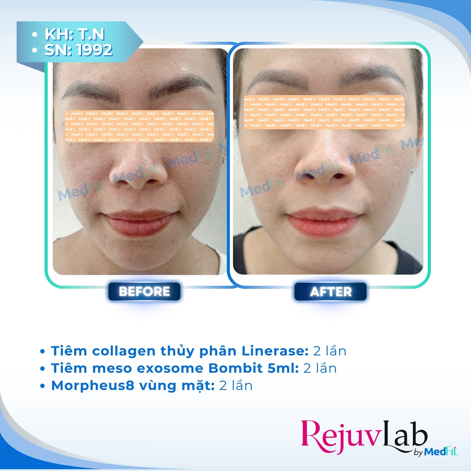 Linerase - Sản phẩm tiêm tăng sinh collagen và tái tạo mô liên kết 4