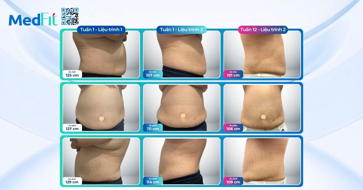 Không chỉ giảm 15,2kg và đẩy lùi bệnh đái tháo đường, khách hàng giảm thêm 7,4kg sau liệu trình 2 tại MedFit 13