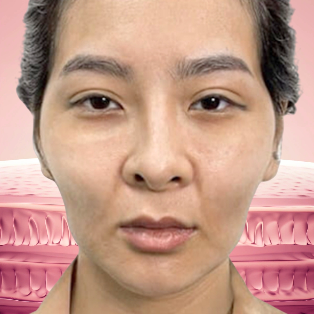 Da bị mất thể tích mô mềm
