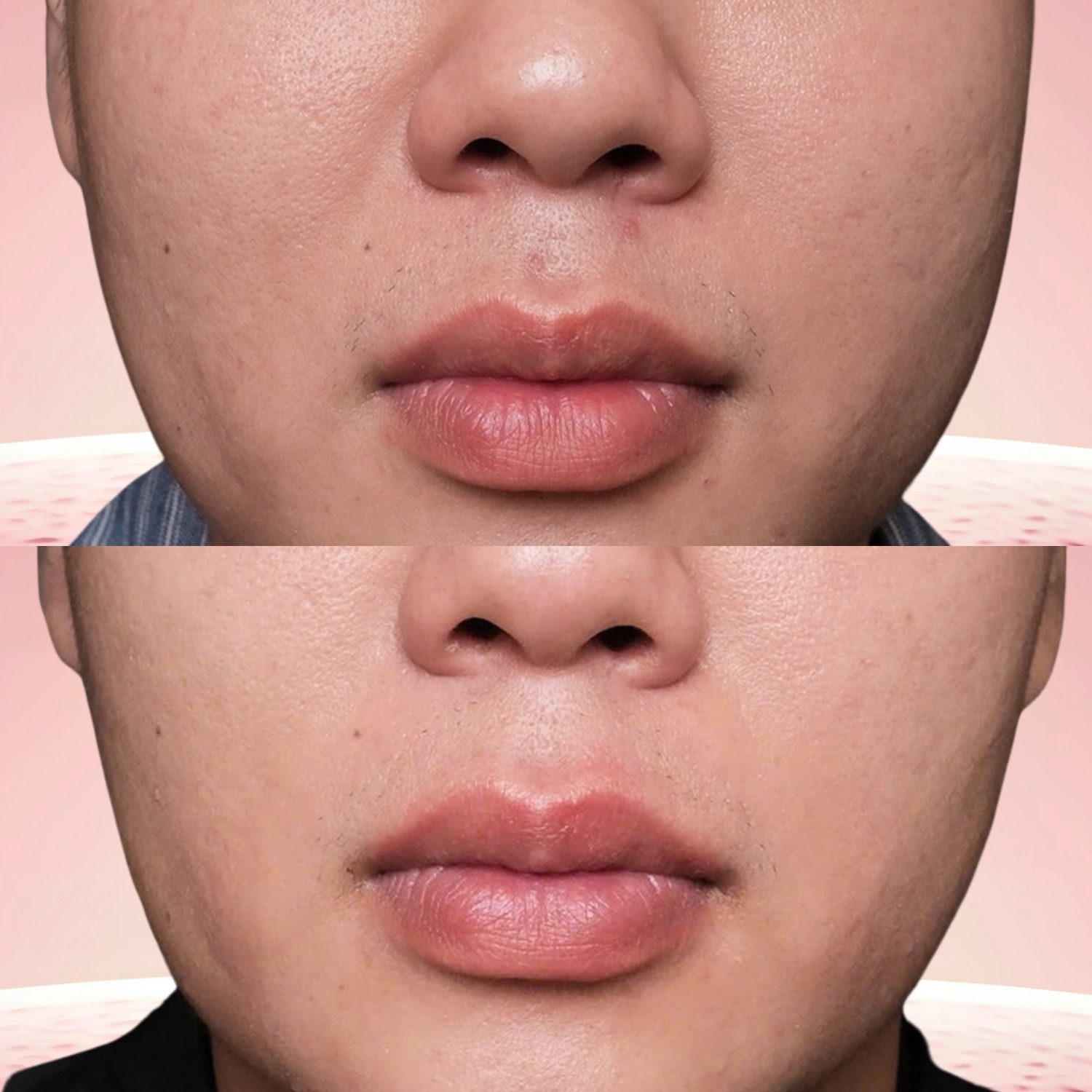 Kết cấu da khỏe hơn nhờ quá trình tái cấu trúc mô dưới da