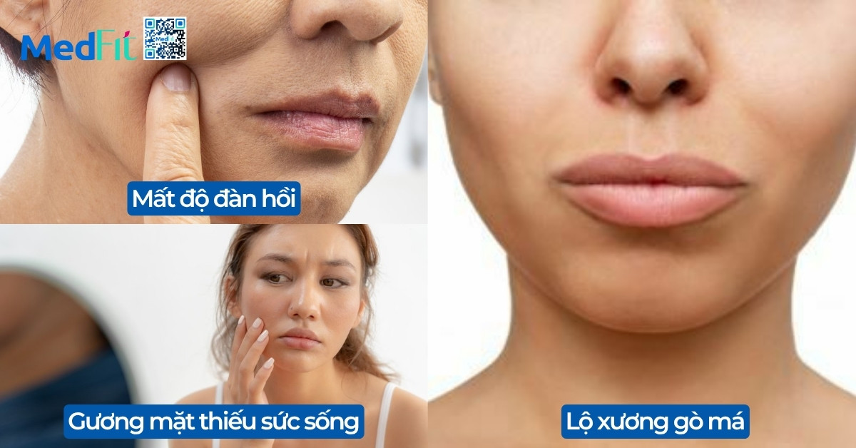 Giảm cân có giảm mỡ mặt không? Cách để mặt không bị hốc hác sau giảm cân 2 Giảm cân có giảm mỡ mặt không? Cách để mặt không bị hốc hác sau giảm cân 1