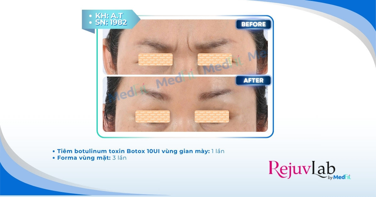 Sự thật về tiêm botox căng da mặt: Có thật sự xóa mờ nếp nhăn? 5 Sự thật về tiêm botox căng da mặt: Có thật sự xóa mờ nếp nhăn? 4