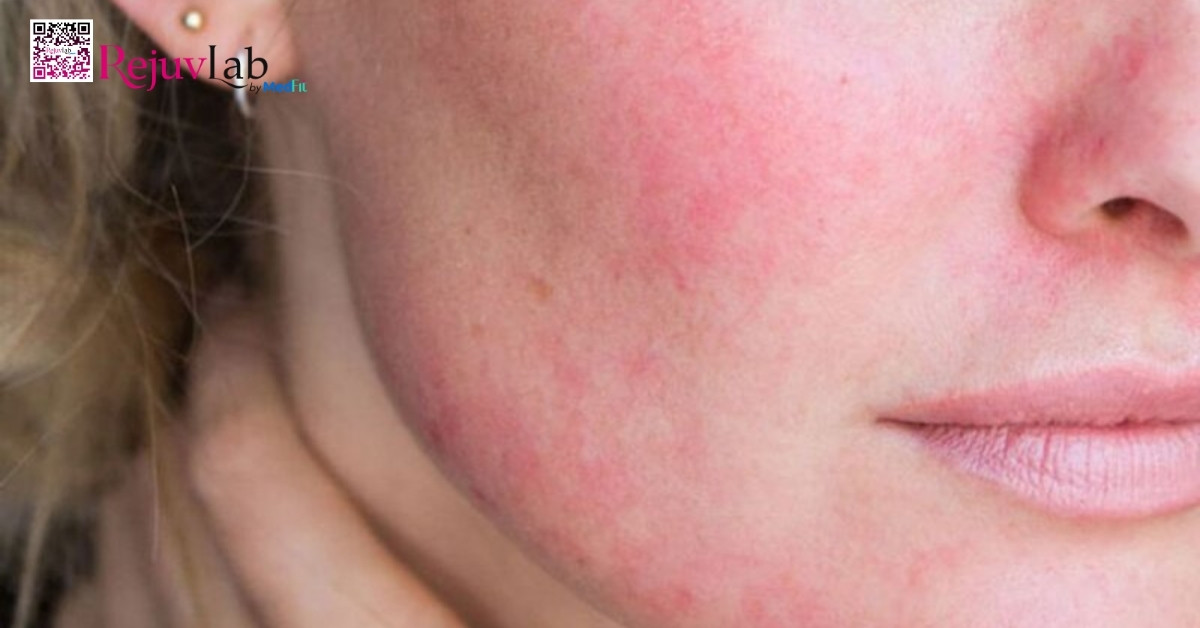 Tiêm botox bị sưng, đau có sao không? Cách xử lý nhanh tại nhà 7 Tiêm botox bị sưng, đau có sao không? Cách xử lý nhanh tại nhà 6