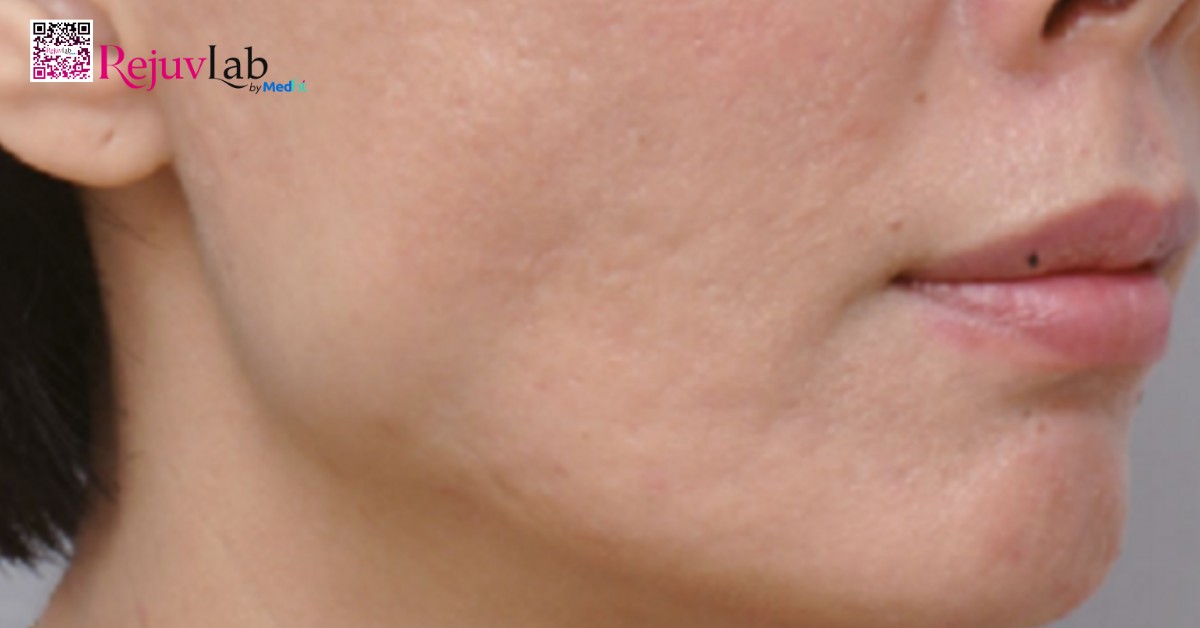Tiêm botox bị sưng, đau có sao không? Cách xử lý nhanh tại nhà 7 Tiêm botox bị sưng, đau có sao không? Cách xử lý nhanh tại nhà 6