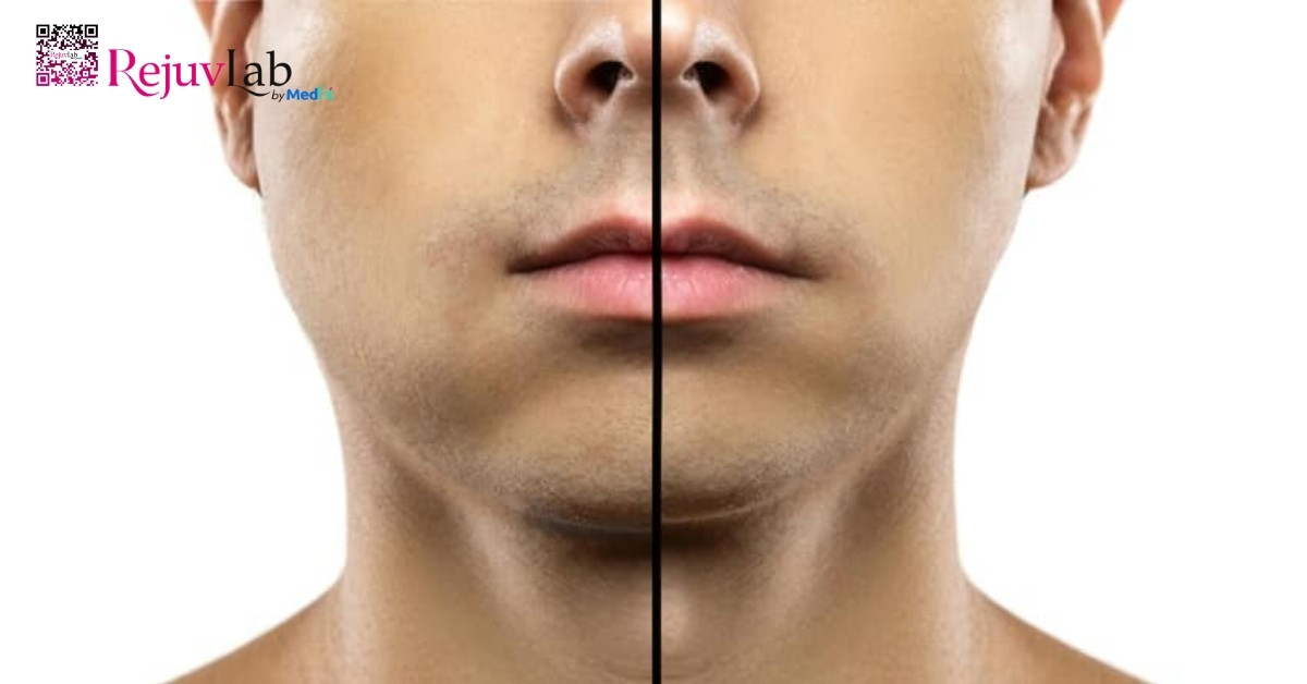 Tiêm botox bị sưng, đau có sao không? Cách xử lý nhanh tại nhà 9 Tiêm botox bị sưng, đau có sao không? Cách xử lý nhanh tại nhà 8