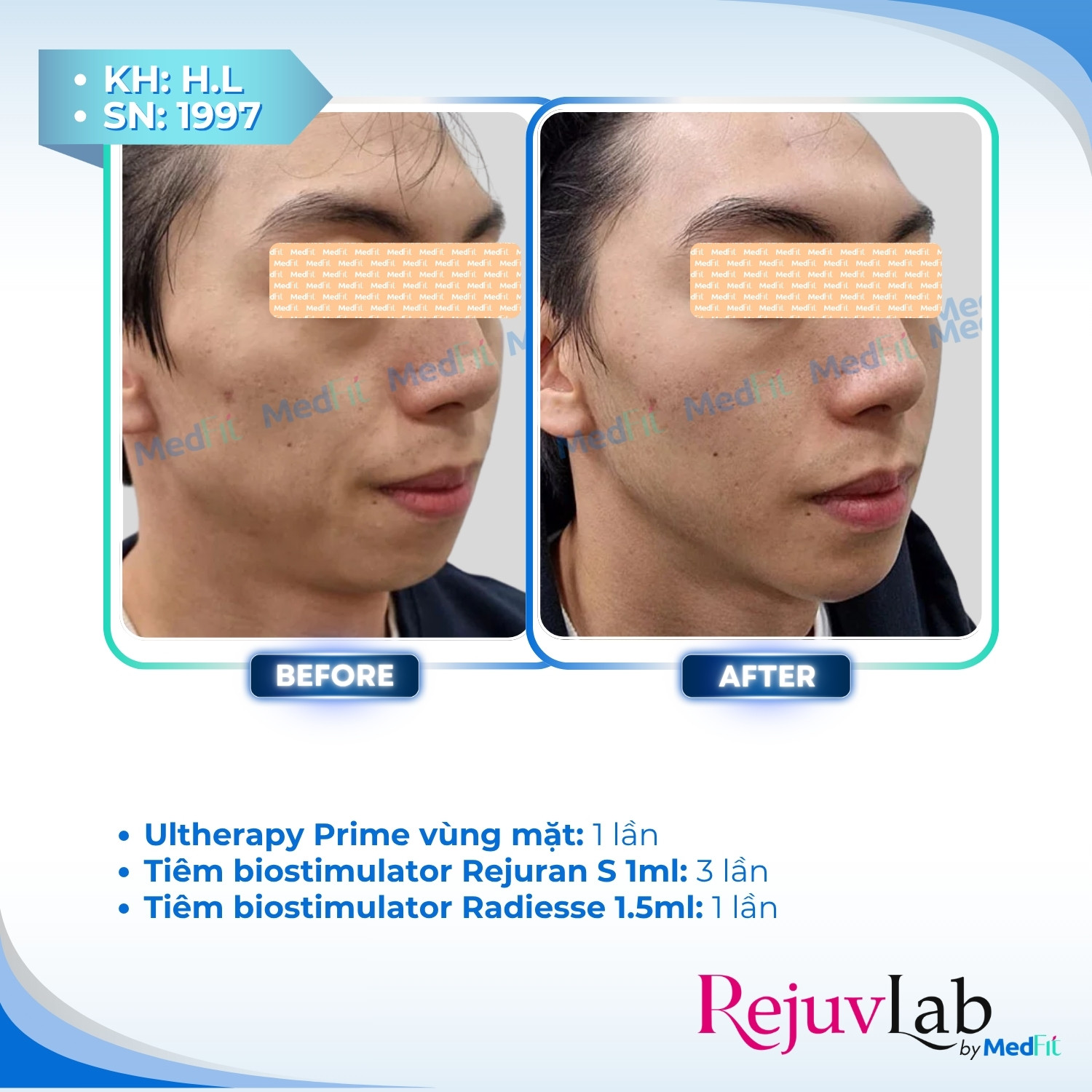 Ultherapy Prime - Tiêu chuẩn vàng của HIFU trong nâng cơ - trẻ hoá da 7