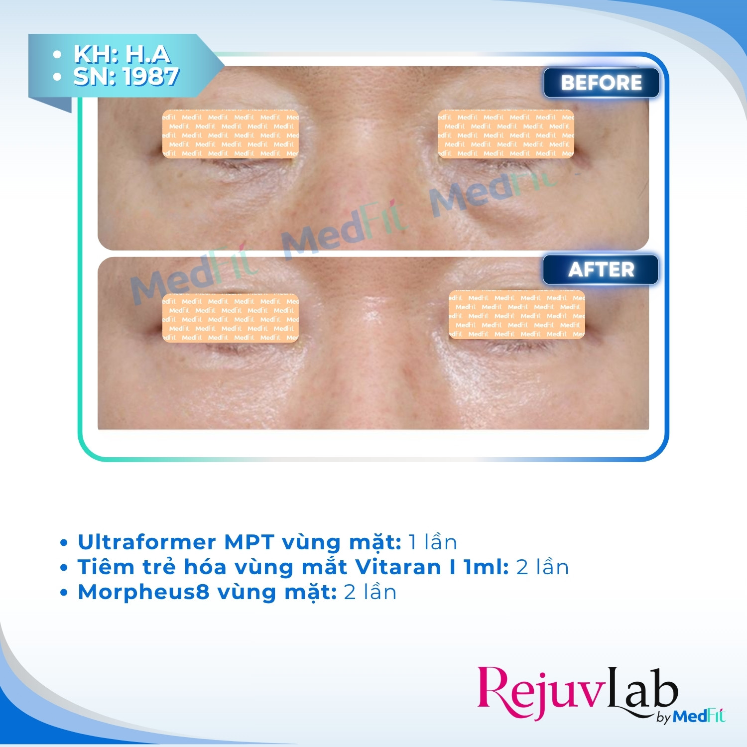 Vitaran I: Trẻ hoá và tái tạo vùng da mỏng manh quanh mắt với Polynucleotide (PN) 2