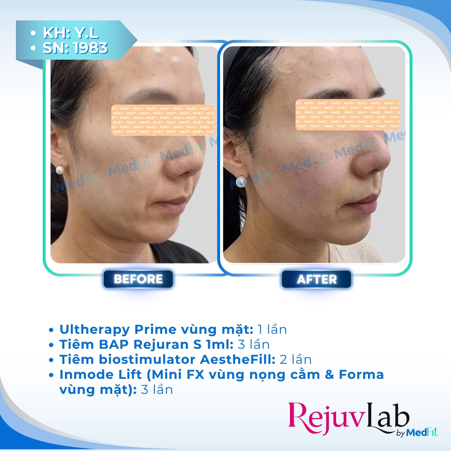 Ultherapy Prime - Tiêu chuẩn vàng của HIFU trong nâng cơ - trẻ hoá da 8