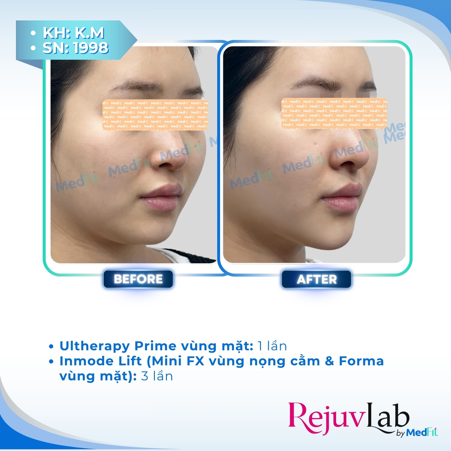 Ultherapy Prime - Tiêu chuẩn vàng của HIFU trong nâng cơ - trẻ hoá da 9