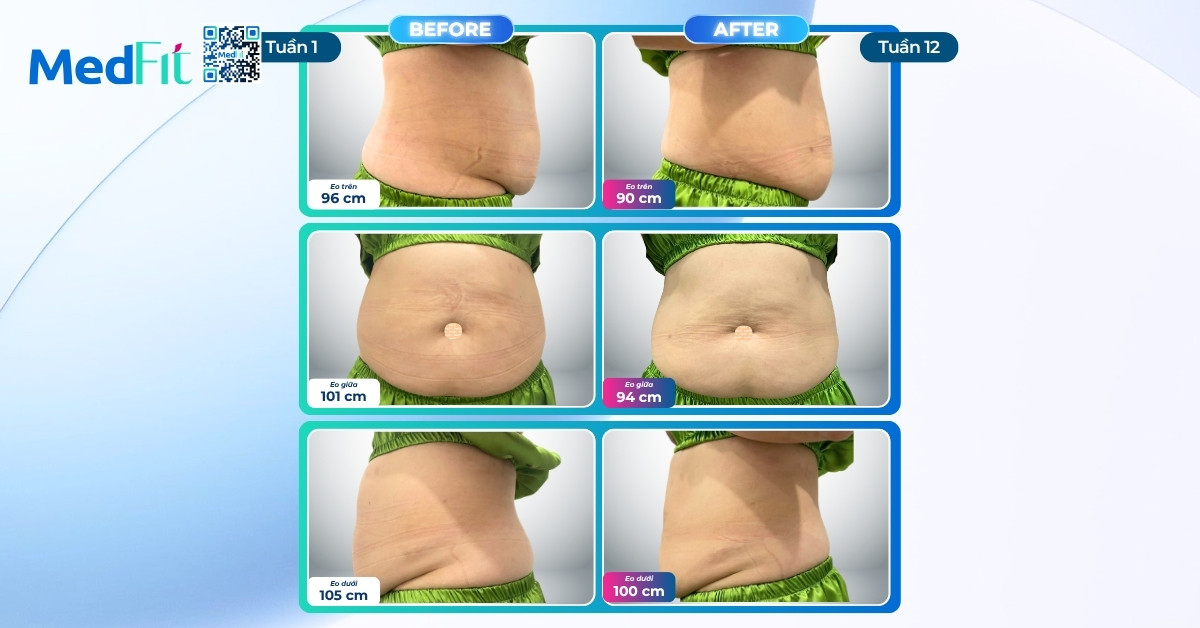 Dù ở xa, vẫn kiên trì 12 tuần, khách hàng giảm hơn 6kg, 18cm vòng eo và mỡ nội tạng tại MedFit 5 Dù ở xa, vẫn kiên trì 12 tuần, khách hàng giảm hơn 6kg, 18cm vòng eo và mỡ nội tạng tại MedFit 4