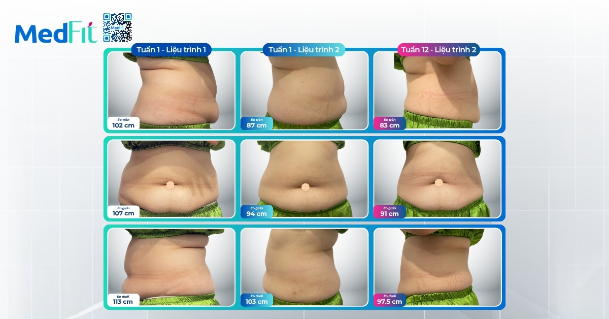 Sau khi giảm 13,2kg, khách hàng tiếp tục giảm 7kg và 12,5cm vòng eo tại MedFit 14