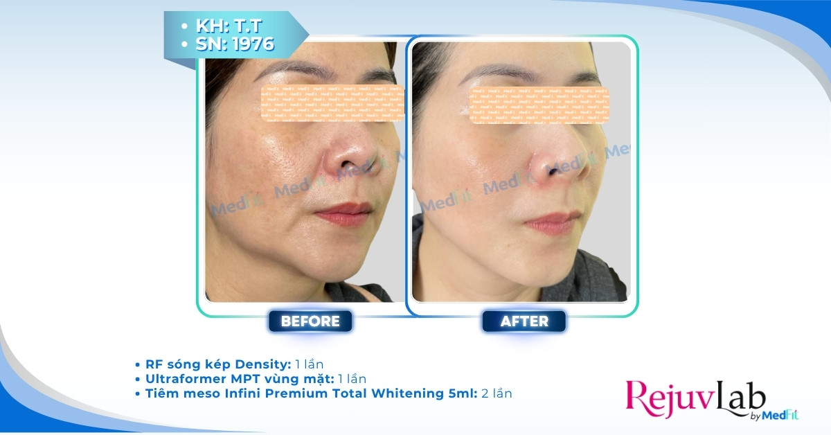 Cách nhận biết sớm biến chứng tiêm meso để tránh tổn thương da vĩnh viễn 17 Cách nhận biết sớm biến chứng tiêm meso để tránh tổn thương da vĩnh viễn 16