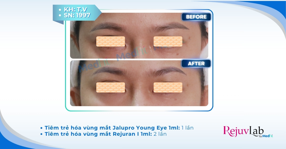 Tiêm meso trị thâm mắt giá bao nhiêu và hiệu quả thực tế thế nào? 19 Tiêm meso trị thâm mắt giá bao nhiêu và hiệu quả thực tế thế nào? 18