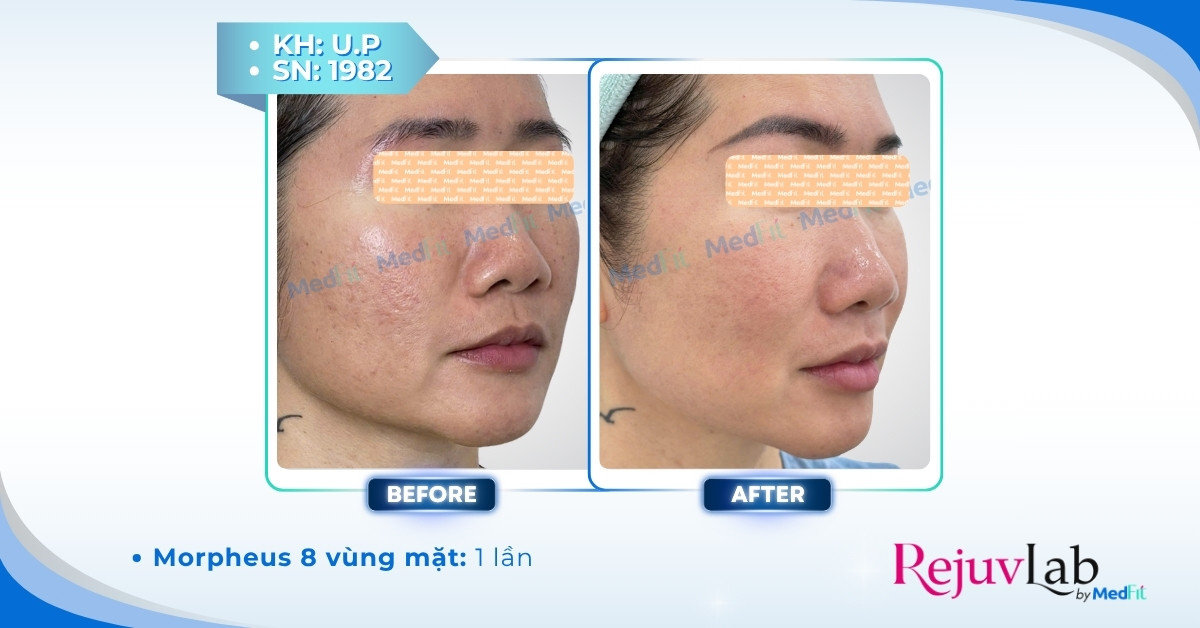 RF vi kim cách điện và không cách điện: Khác nhau thế nào, nên chọn loại nào? 15 RF vi kim cách điện và không cách điện: Khác nhau thế nào, nên chọn loại nào? 14