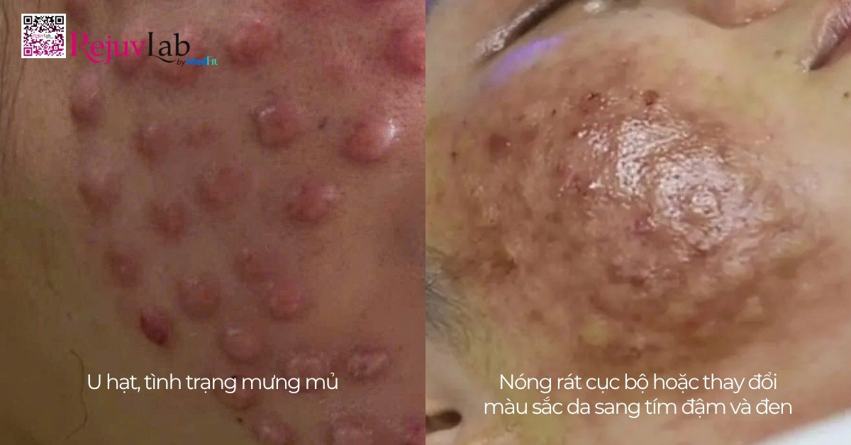 Lưu ý sau khi tiêm meso để làn da nhanh phục hồi và căng mọng 5 Lưu ý sau khi tiêm meso để làn da nhanh phục hồi và căng mọng 4