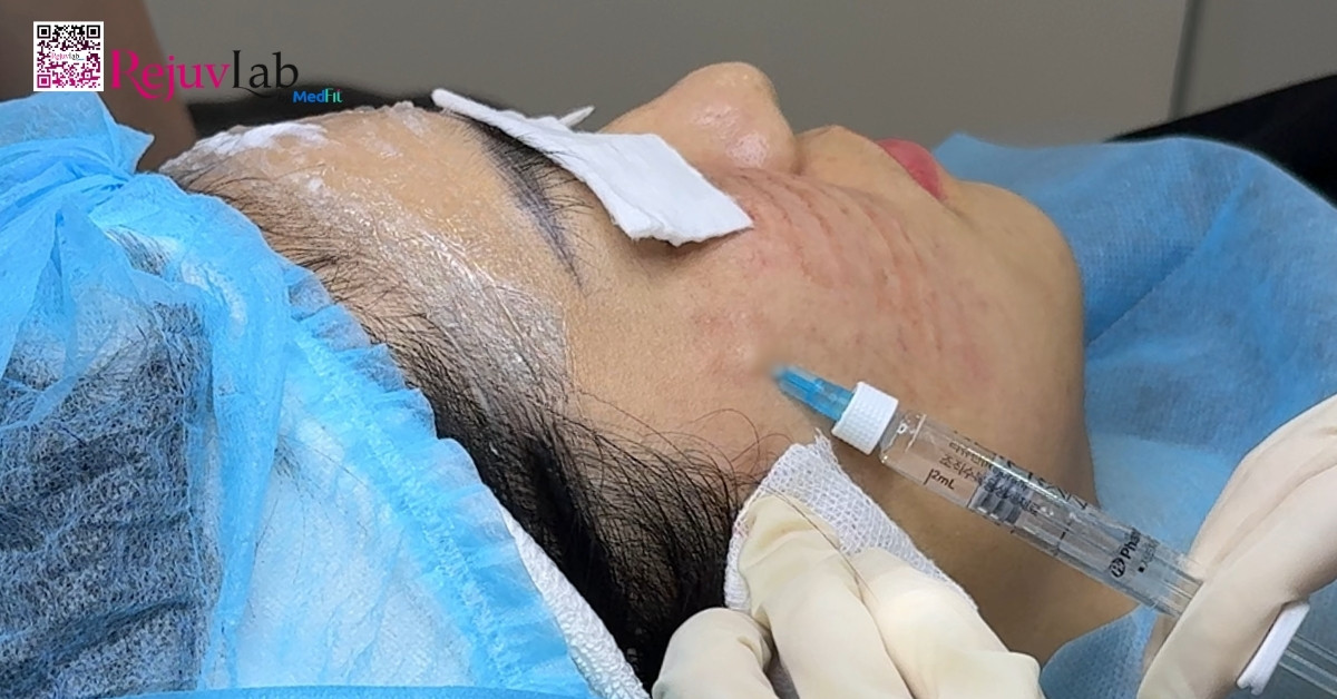 7 loại meso phổ biến và bí quyết lựa chọn hoạt chất phù hợp cho làn da 2 7 loại meso phổ biến và bí quyết lựa chọn hoạt chất phù hợp cho làn da 1