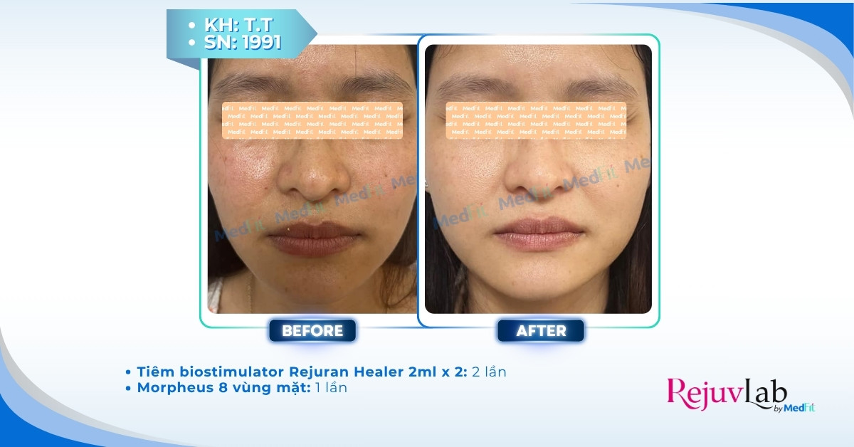 Tiêm meso phục hồi da và những lợi ích bất ngờ cho làn da mỏng yếu 9 Tiêm meso phục hồi da và những lợi ích bất ngờ cho làn da mỏng yếu 8
