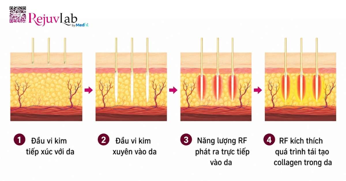 RF vi kim cách điện và không cách điện: Khác nhau thế nào, nên chọn loại nào? 2 RF vi kim cách điện và không cách điện: Khác nhau thế nào, nên chọn loại nào? 1