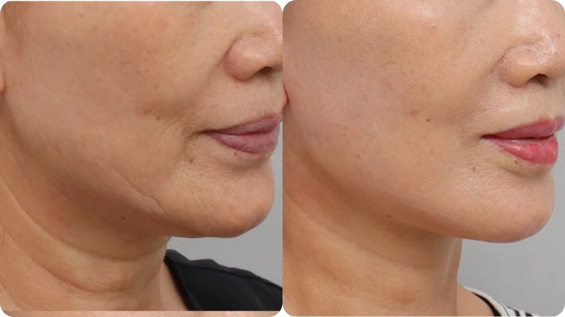 Giảm nếp nhăn và làm mờ các rãnh sâu
