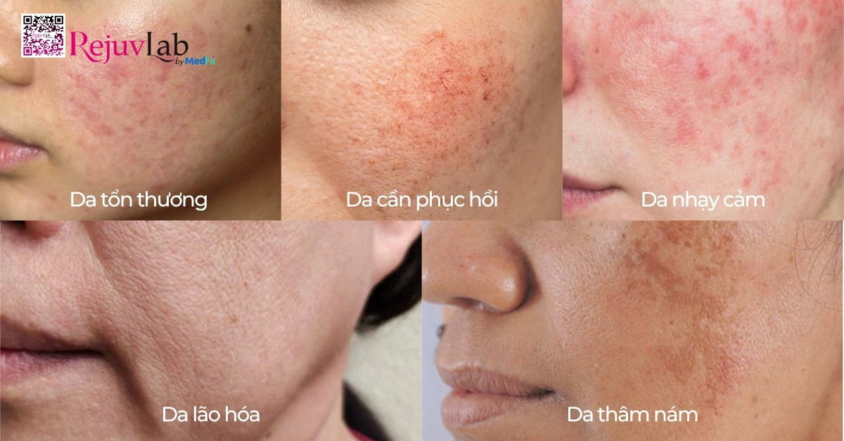 Tiêm meso phục hồi da và những lợi ích bất ngờ cho làn da mỏng yếu 7 Tiêm meso phục hồi da và những lợi ích bất ngờ cho làn da mỏng yếu 6