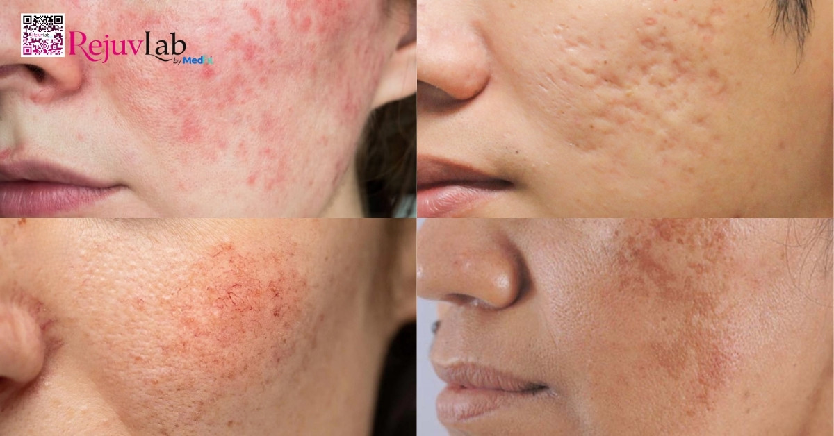 Tiêm meso phục hồi da và những lợi ích bất ngờ cho làn da mỏng yếu 7 Tiêm meso phục hồi da và những lợi ích bất ngờ cho làn da mỏng yếu 6