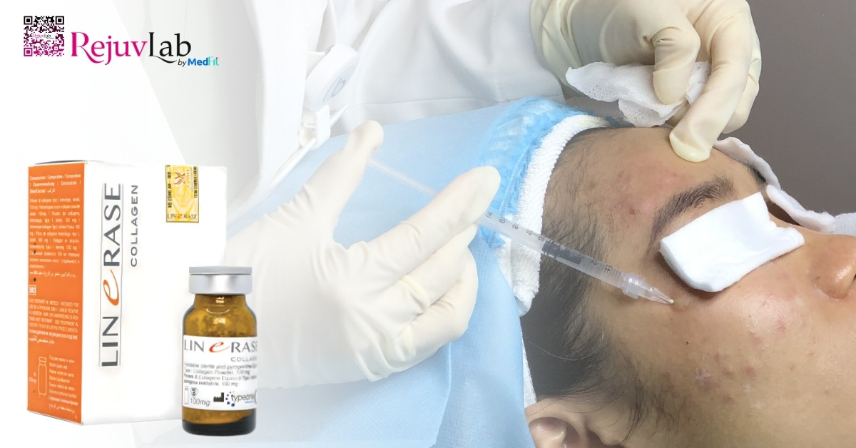 Tiêm meso loại nào tốt? Bí quyết chọn đúng sản phẩm để không lãng phí tiền bạc 20 Tiêm meso loại nào tốt? Bí quyết chọn đúng sản phẩm để không lãng phí tiền bạc 19