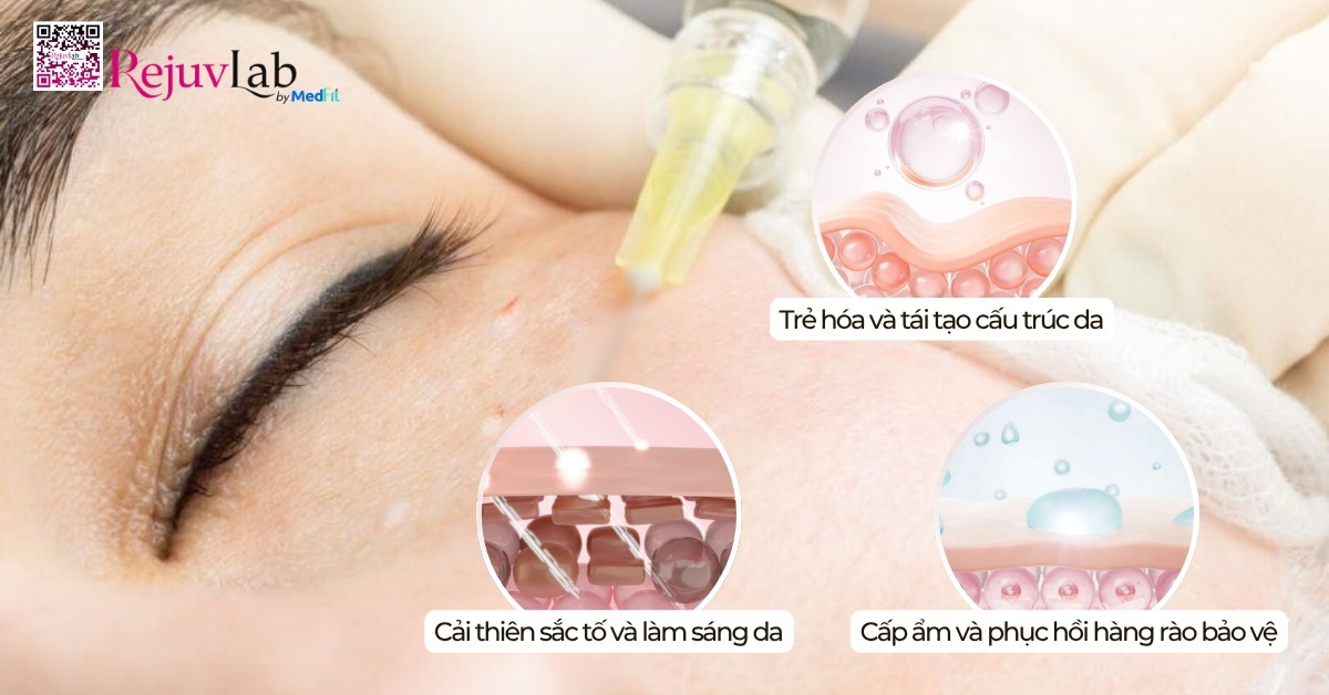 Tiêm meso vùng mắt: Giải pháp cải thiện quầng thâm và nếp nhăn li ti hiệu quả 4 Tiêm meso vùng mắt: Giải pháp cải thiện quầng thâm và nếp nhăn li ti hiệu quả 3
