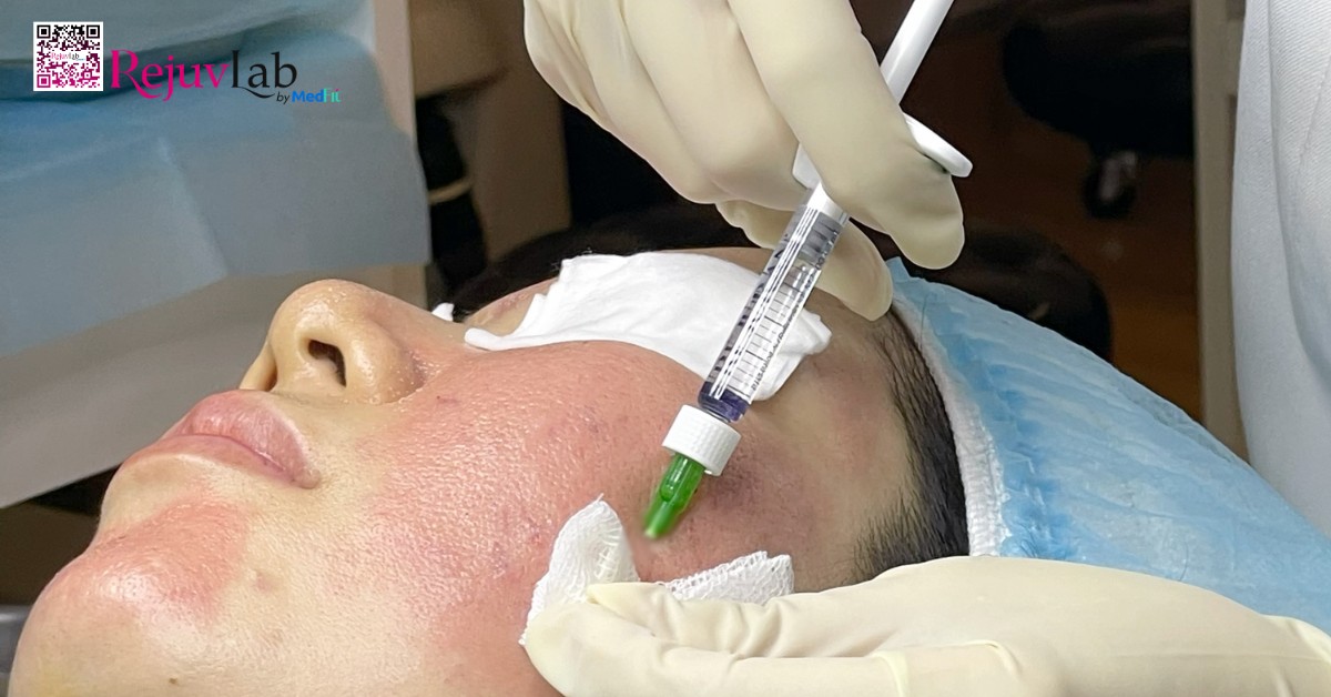 7 loại meso phổ biến và bí quyết lựa chọn hoạt chất phù hợp cho làn da 17 7 loại meso phổ biến và bí quyết lựa chọn hoạt chất phù hợp cho làn da 16