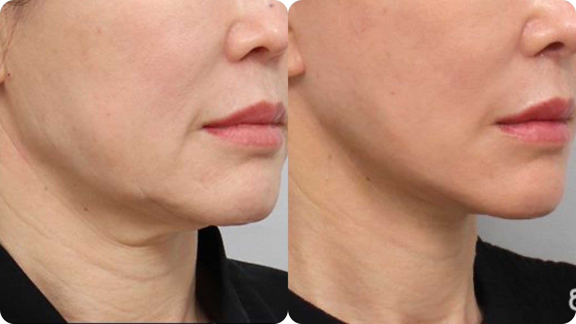 Nâng cơ và cải thiện độ săn chắc da