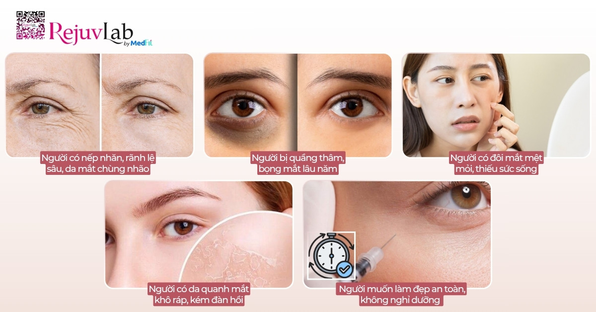 Tiêm meso trị thâm mắt giá bao nhiêu và hiệu quả thực tế thế nào? 10 Tiêm meso trị thâm mắt giá bao nhiêu và hiệu quả thực tế thế nào? 9