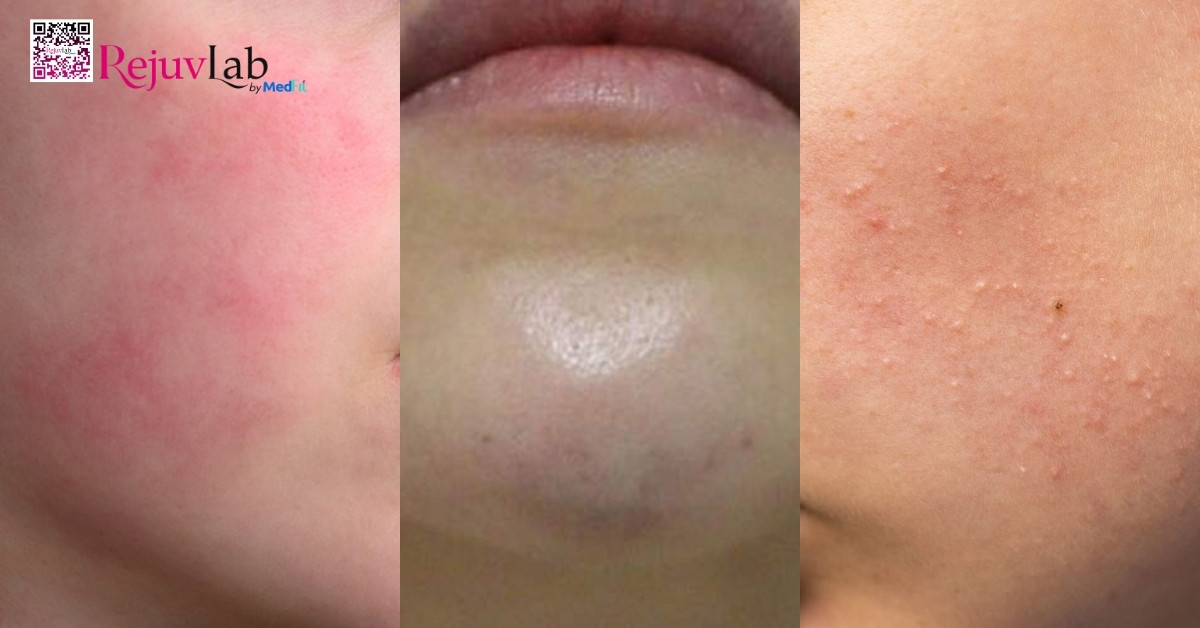 Cách nhận biết sớm biến chứng tiêm meso để tránh tổn thương da vĩnh viễn 2 Cách nhận biết sớm biến chứng tiêm meso để tránh tổn thương da vĩnh viễn 1