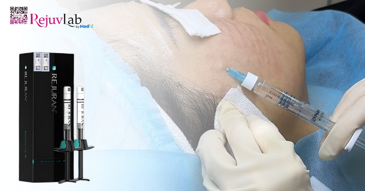 Tiêm meso loại nào tốt? Bí quyết chọn đúng sản phẩm để không lãng phí tiền bạc 22 Tiêm meso loại nào tốt? Bí quyết chọn đúng sản phẩm để không lãng phí tiền bạc 21
