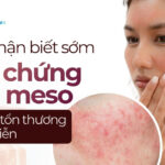 Cách nhận biết sớm biến chứng tiêm meso để tránh tổn thương da vĩnh viễn