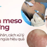 Tiêm meso bị sưng: Nguyên nhân, cách xử lý và phòng ngừa hiệu quả