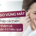 Tiêm meso vùng mắt: Giải pháp cải thiện quầng thâm và nếp nhăn li ti hiệu quả