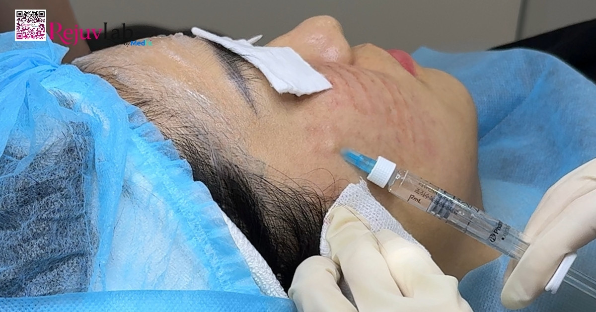 Tiêm meso phục hồi da và những lợi ích bất ngờ cho làn da mỏng yếu 5 Tiêm meso phục hồi da và những lợi ích bất ngờ cho làn da mỏng yếu 4