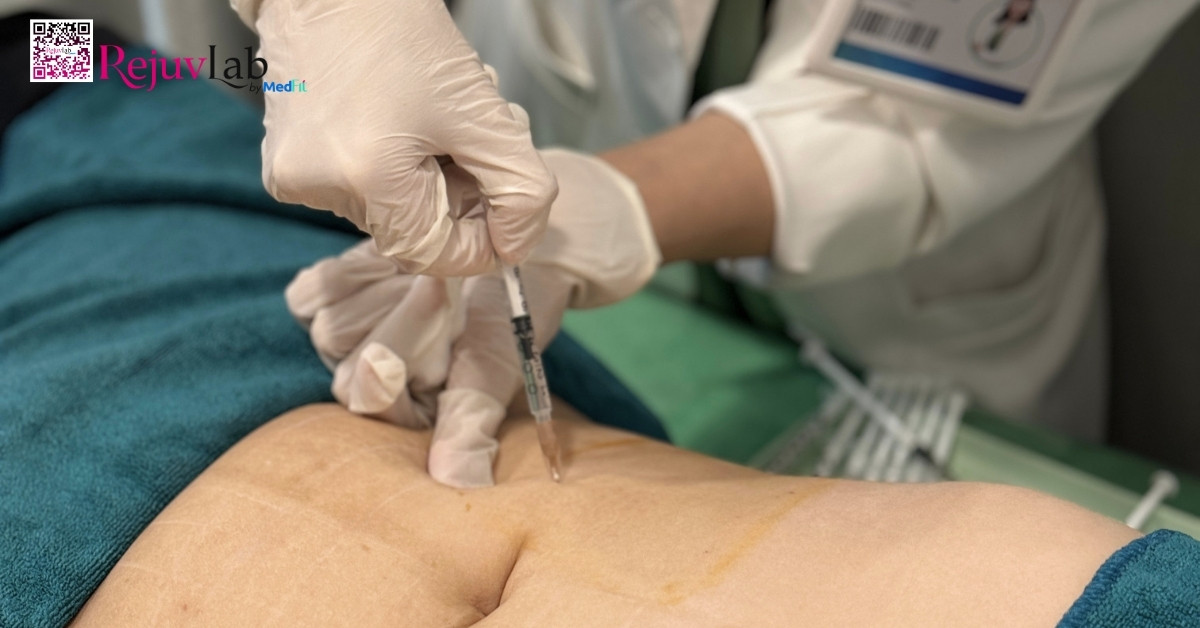 Tiêm meso loại nào tốt? Bí quyết chọn đúng sản phẩm để không lãng phí tiền bạc 4 Tiêm meso loại nào tốt? Bí quyết chọn đúng sản phẩm để không lãng phí tiền bạc 3